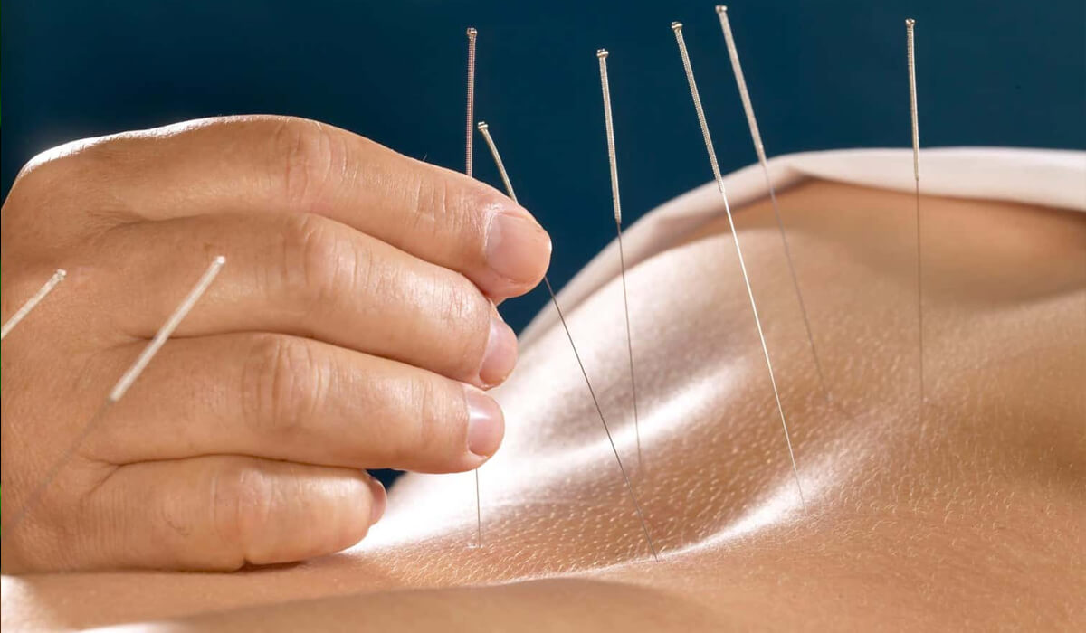 Acupuncture Therapy